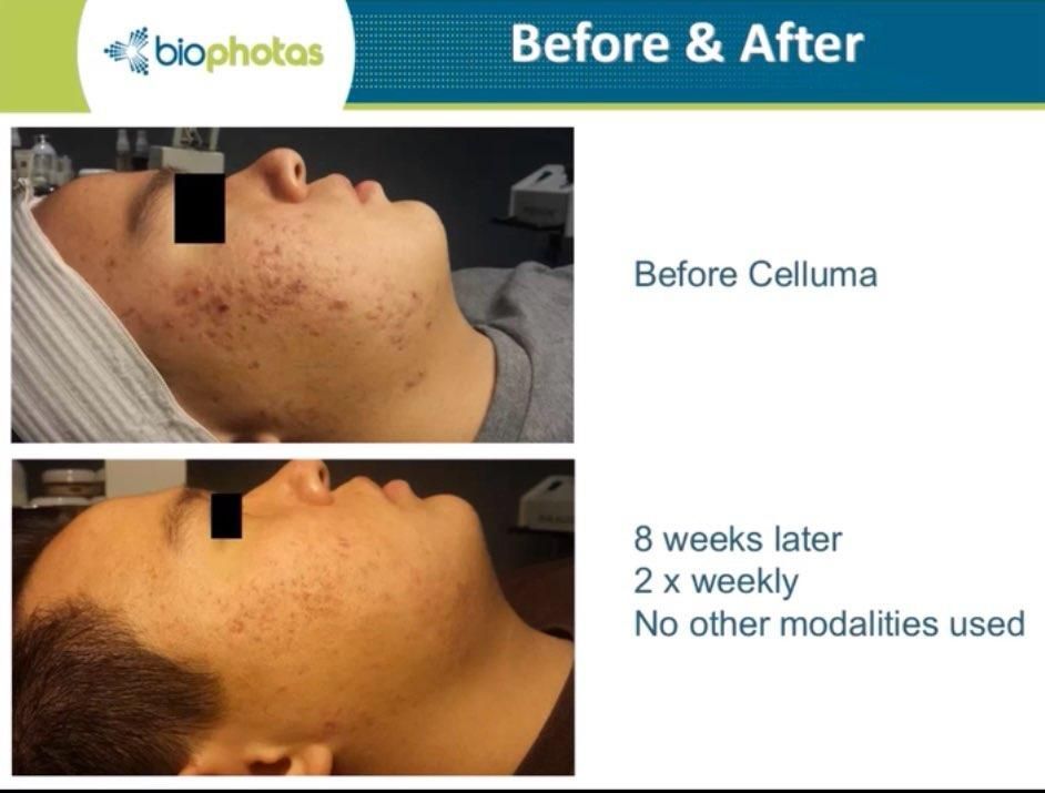 Side-by-side comparison of a person's skin before and after Celluma treatment, showing reduced acne.