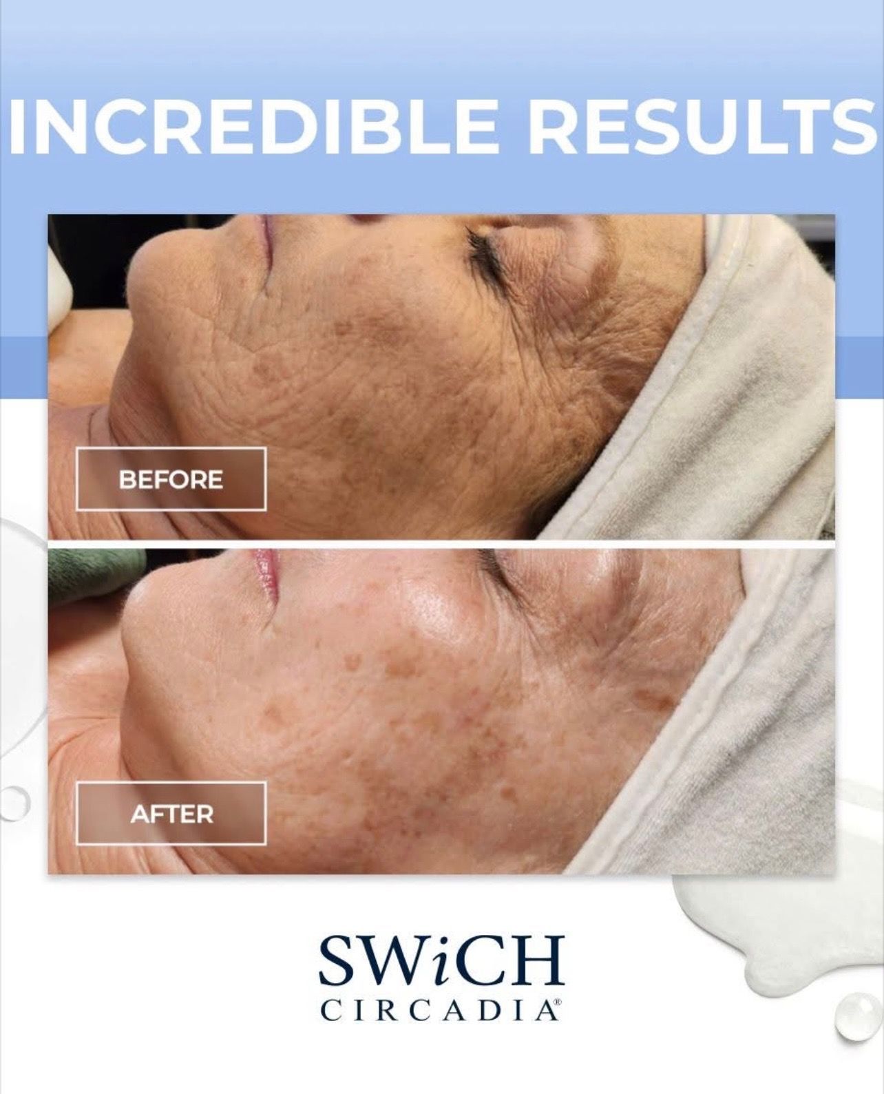 Side-by-side comparison of skin before and after treatment, showing reduction in wrinkles and dark spots.