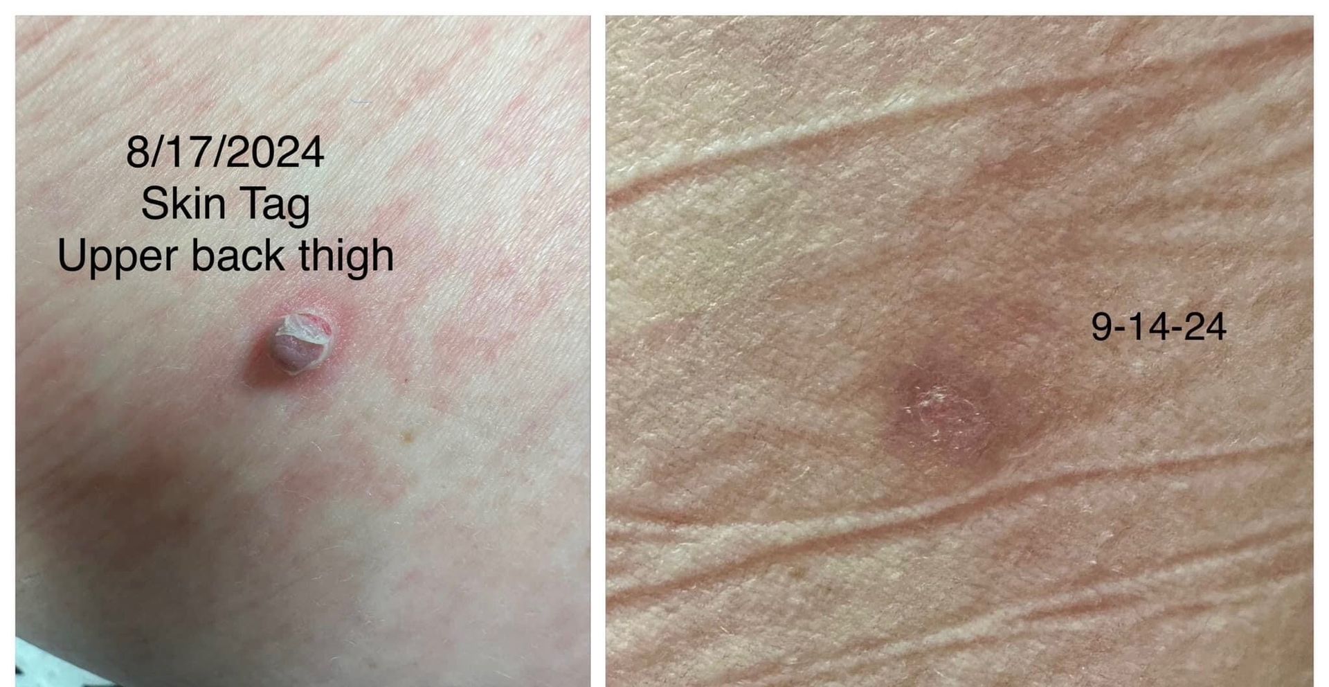 Two close-up photos of a skin tag on a thigh, with dates 6/17/2024 and 3-14-24.