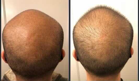 Comparison of shaved head before (left) and after (right) hair growth treatment.