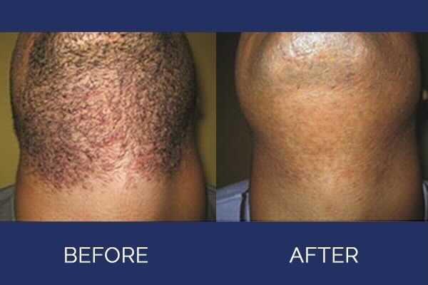 Before and after comparison of a neck, showing hair growth and then smooth skin.