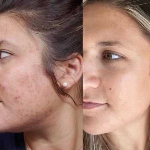 Side-by-side photos of a woman's face, showing skin with dark spots (left) and clear skin (right).