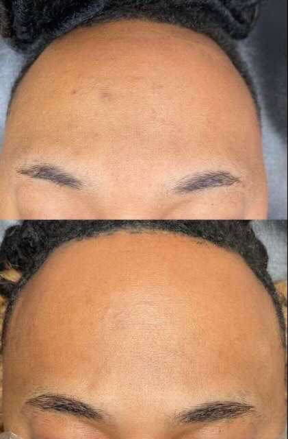 Forehead comparison: Before and after skin treatment, with visible reduction in blemishes.