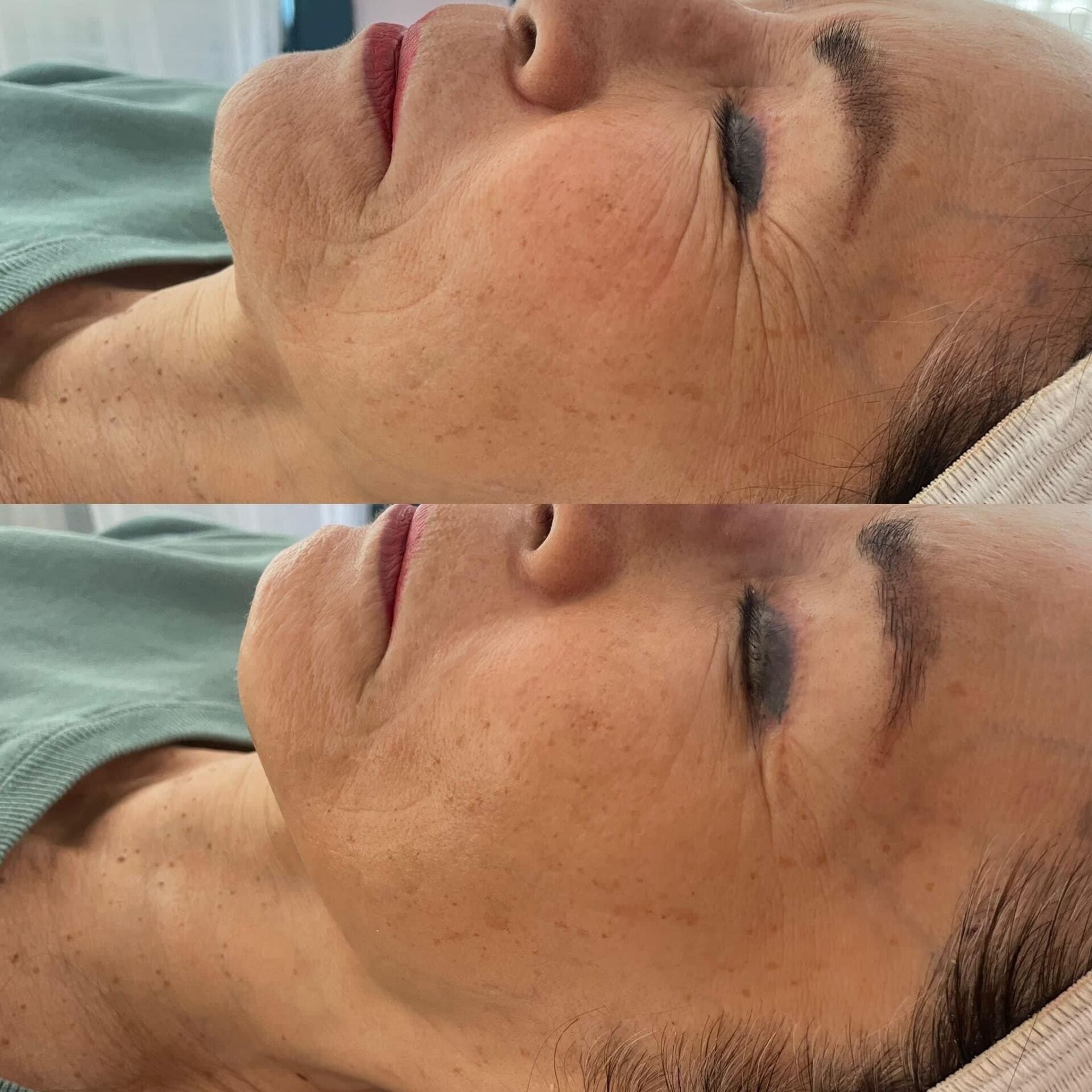 Two side-by-side photos of a person's face. Top shows wrinkles, bottom shows smoother skin, both with eyes closed.