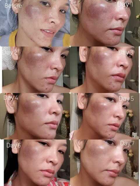 Woman's face shows progression of a bruise over seven days. Dark purple discoloration fades, reducing in intensity.