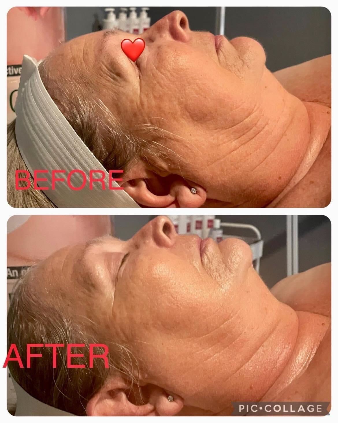 Side-by-side comparison of a person's face. Top: before, showing wrinkles. Bottom: after, with smoother skin.