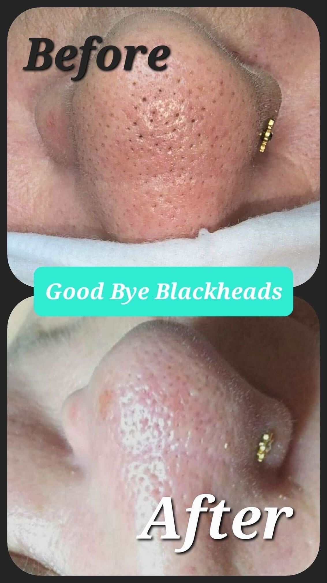 Before and after comparison of a nose with visible blackheads, followed by a smoother appearance.