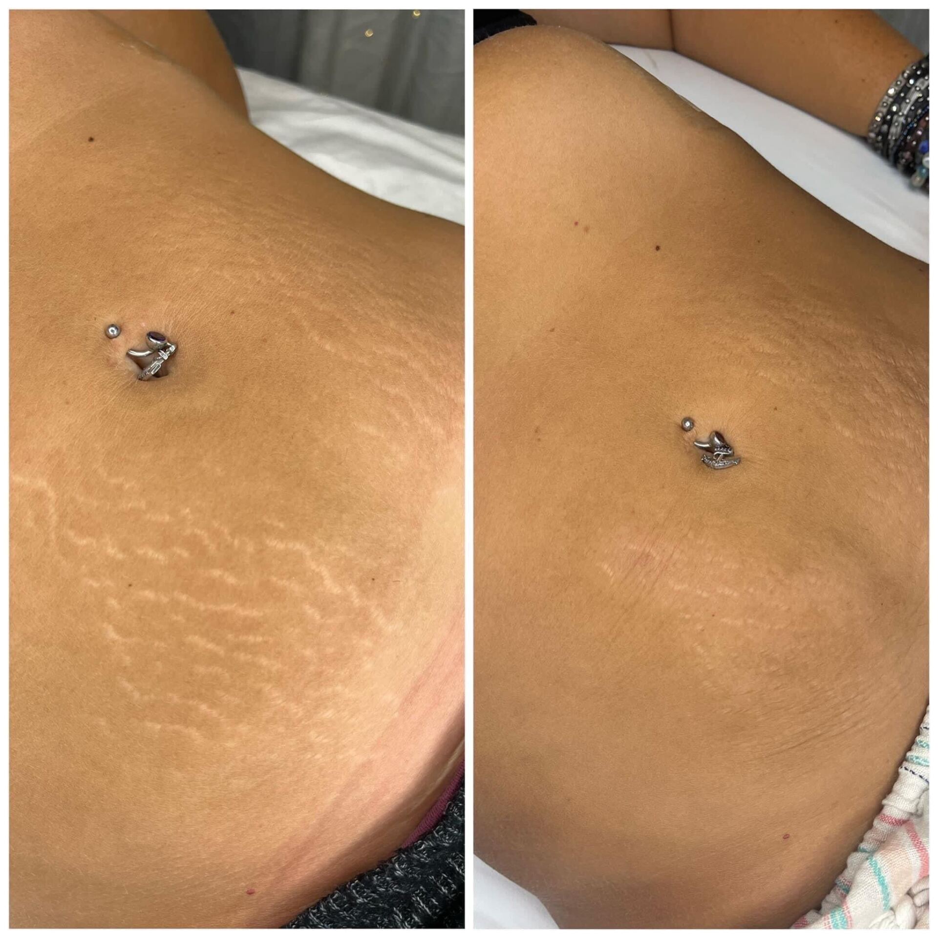 Two photos comparing skin with stretch marks before and after treatment, near a navel piercing.