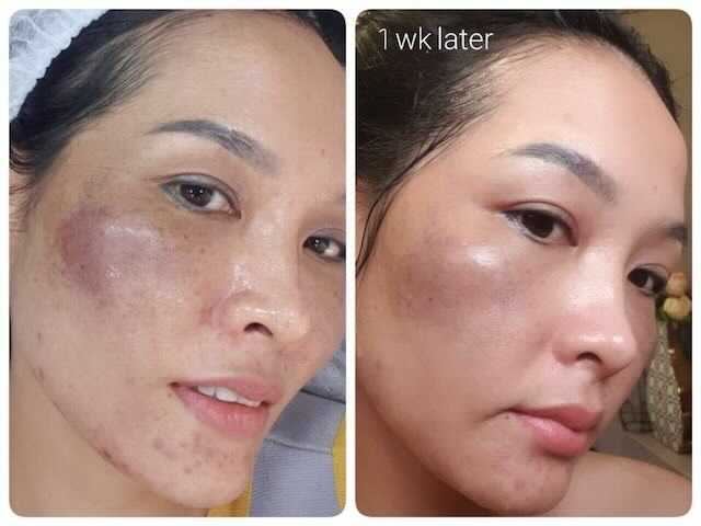 Side-by-side photos of a person's face. Left shows facial discoloration, right shows improvement 1 week later.