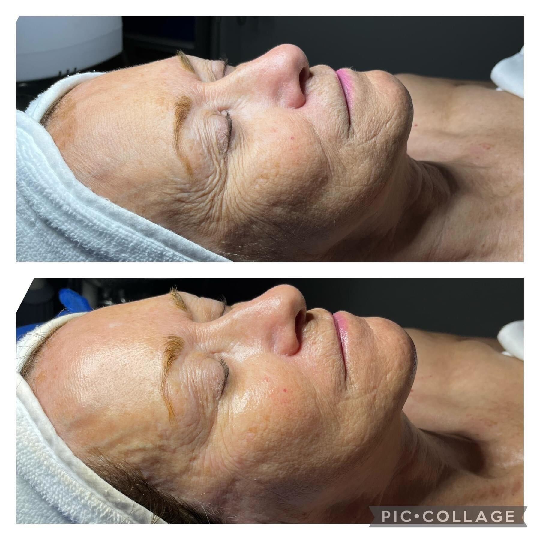 Before and after comparison of a person's face. Top: wrinkled skin. Bottom: Smoother skin. Eyes closed.
