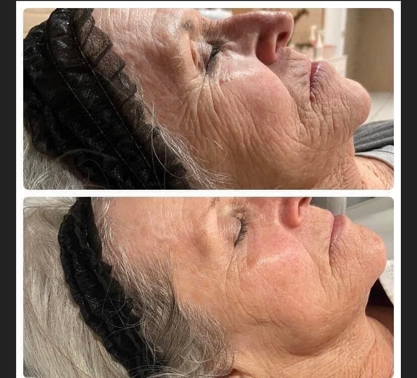 Before and after comparison of woman's face. Top image: wrinkled skin. Bottom image: smoother skin.