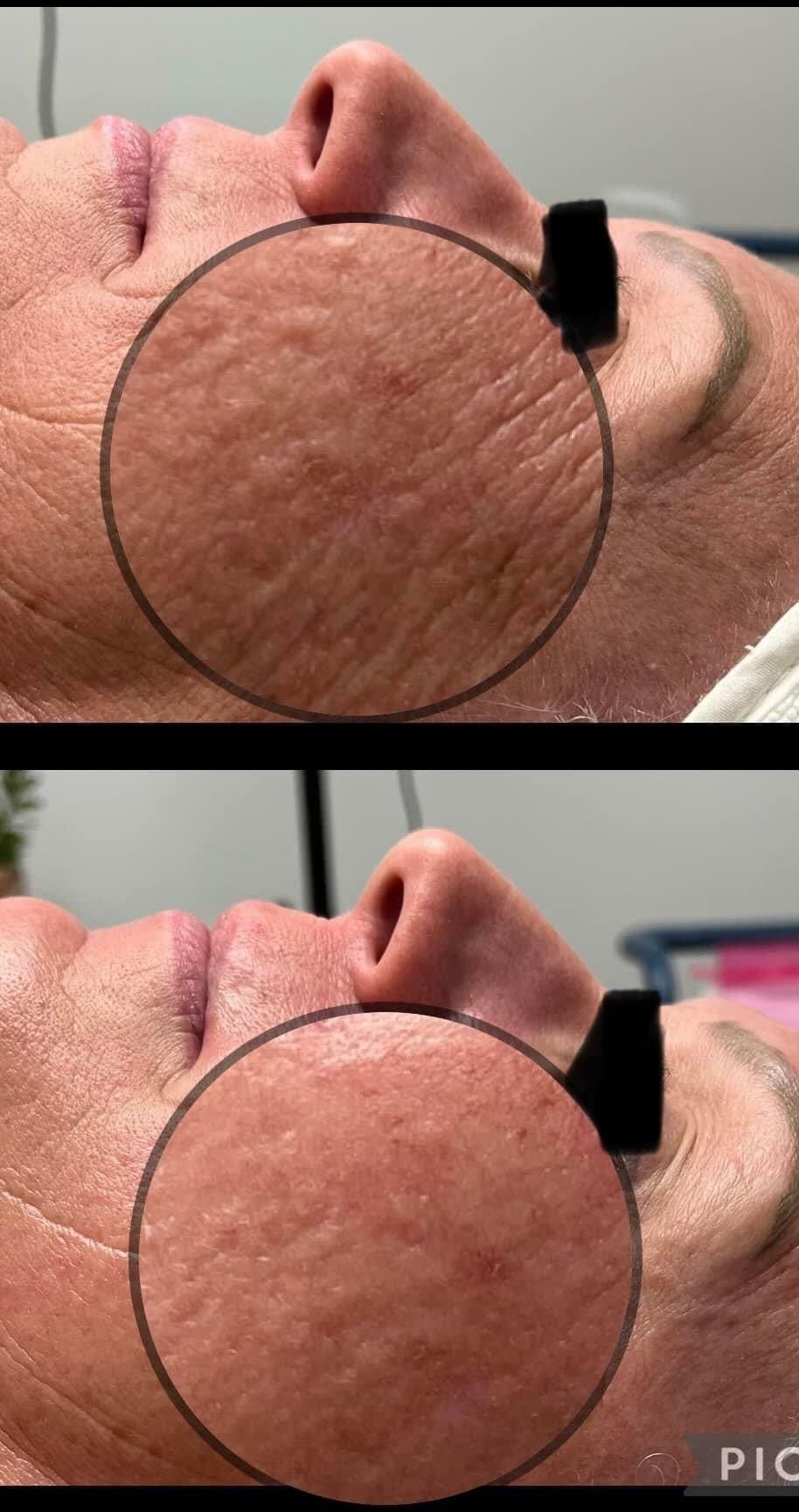 Before and after facial skin texture comparison. Top: wrinkles, Bottom: smoother skin.