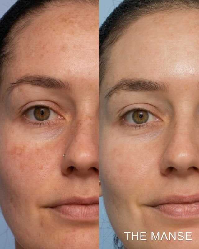 Before and after comparison of a person's face; skin appears lighter and more even-toned.