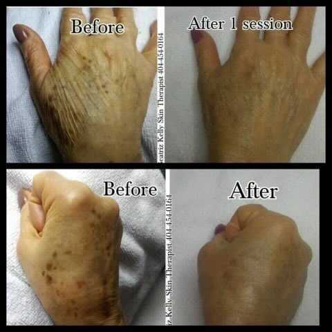 Hands showing skin discoloration before and after a treatment session.
