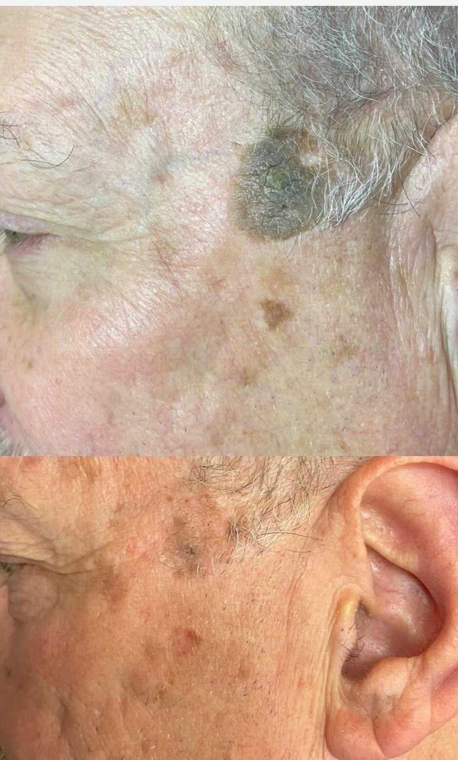 Before and after views of aged skin with several dark spots, possibly a mole, near the ear.