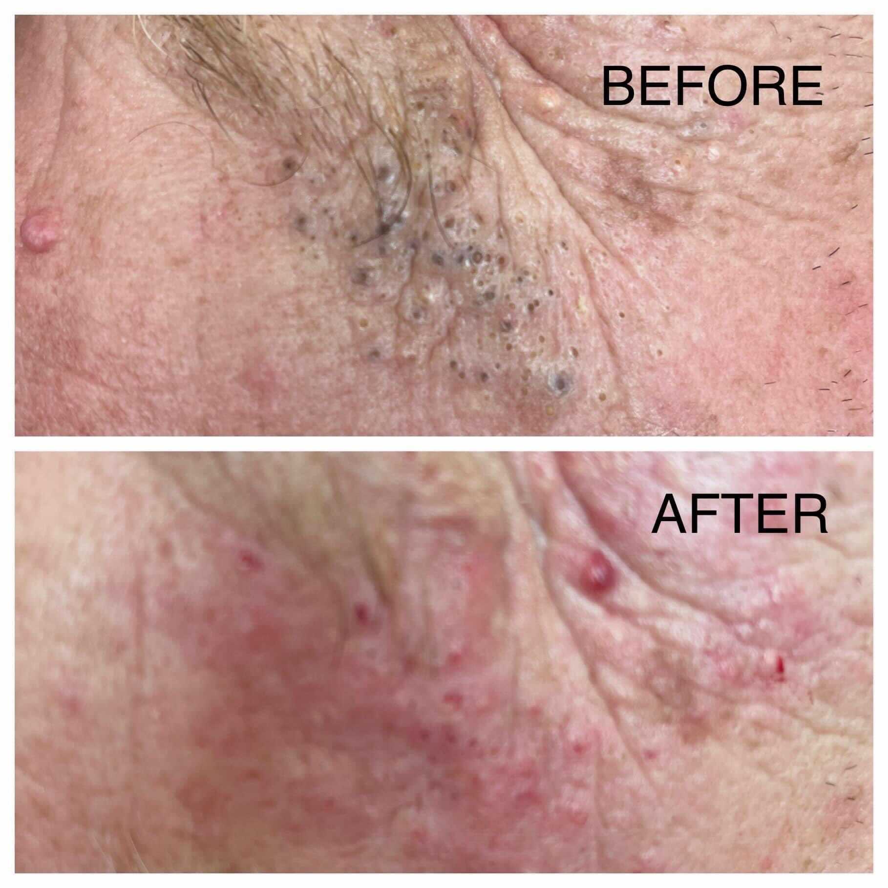 Comparison of skin condition before and after treatment, showing changes in texture and color.
