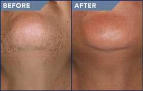 Side-by-side comparison of a person's chin and neck; before shows dark facial hair, after is smooth.