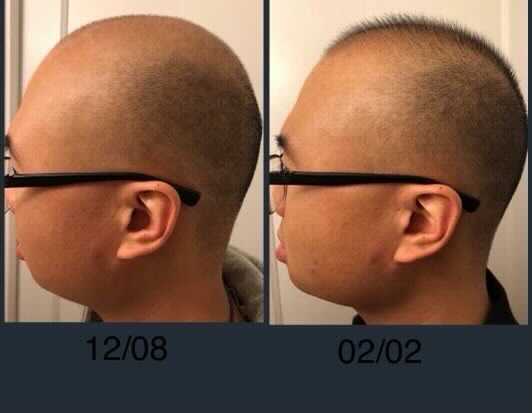 Side-by-side comparison of a person's head profile. Left image, dated 12/08, shows more pronounced neck fat.