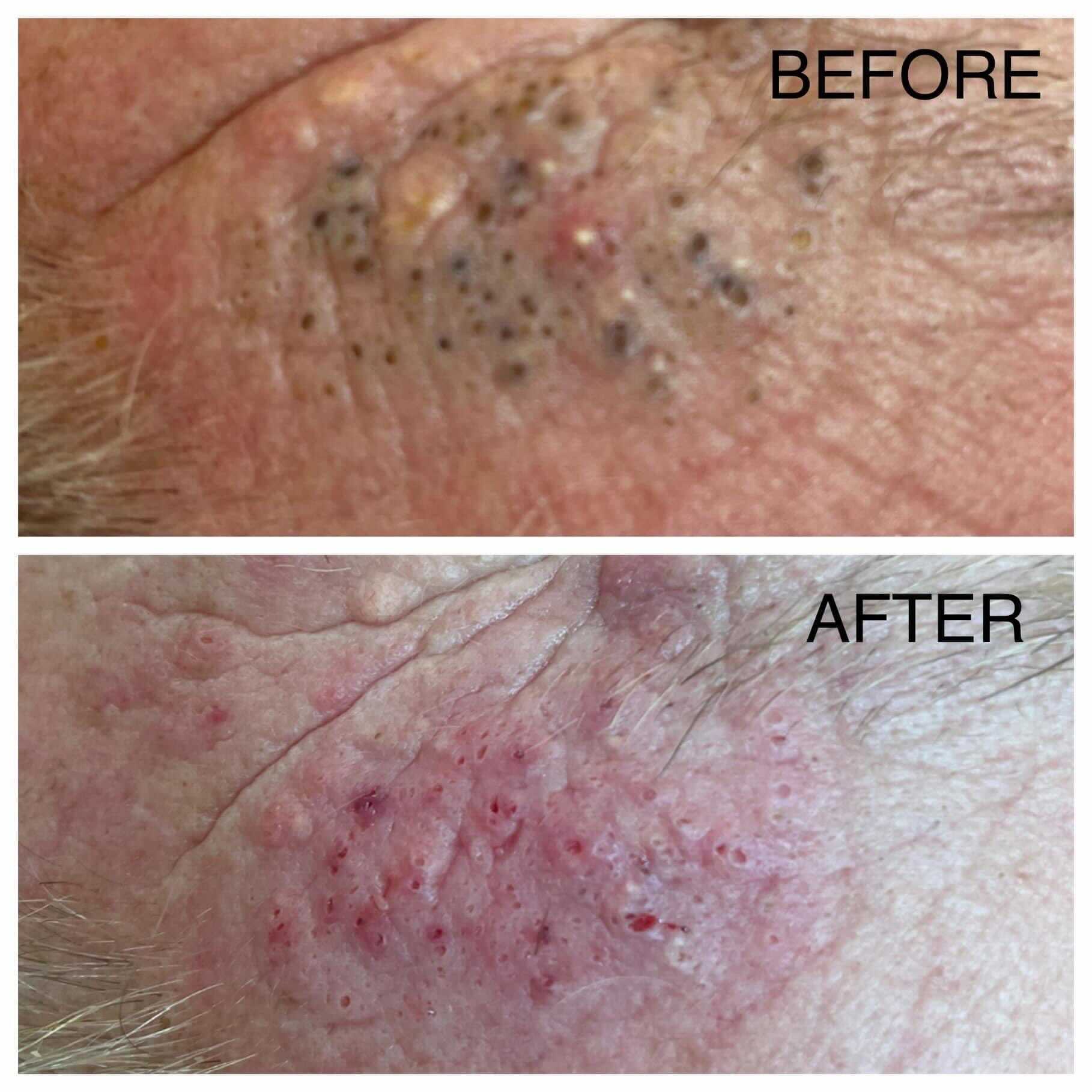 Skin condition before and after treatment. Before: black spots and bumps. After: red, irritated skin.