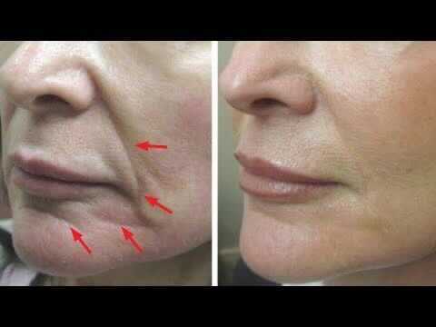 Before and after view of a face, showing reduced wrinkles after cosmetic treatment.