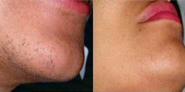 Side-by-side comparison of a person's chin before and after hair removal, showing a reduction in hair.