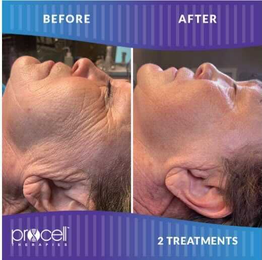 Side-by-side comparison of a person's face. Before photo shows wrinkles. After photo shows reduced wrinkles