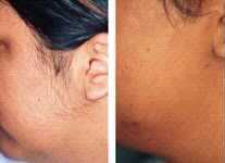 Comparison of a woman's face, before and after hair removal. Left: Hairy. Right: Smooth, clean.