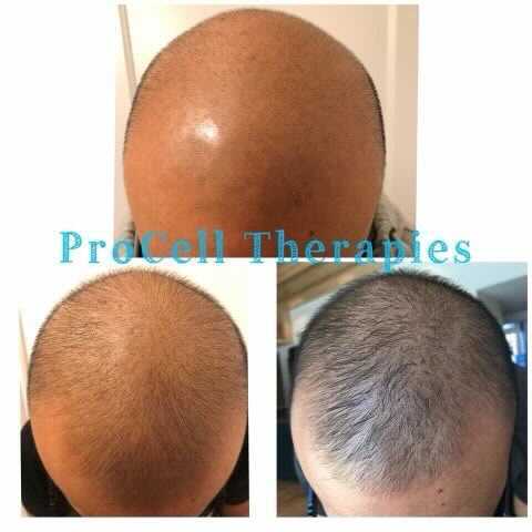 Before and after views of a head with hair growth, a treatment result.