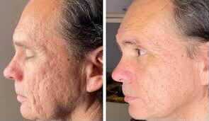 Before and after photos of a man's face, showing a reduction in acne scars after treatment.