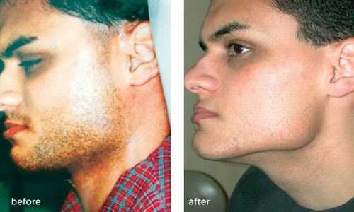 Side-by-side comparison of a man's face before and after jawline surgery; different lighting, close-up view.