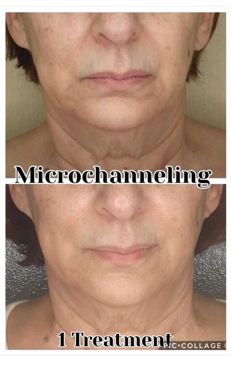 Comparison of woman's neck and face before and after microchanneling treatment, showing reduced wrinkles.
