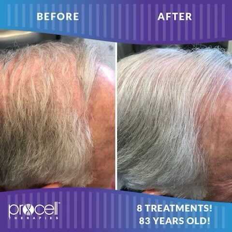 Before and after comparison of hair, showing improvement after 8 treatments. White hair, 83 years old.