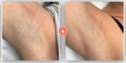 Before and after of a shaved armpit; showing dark hairs, then smooth skin.