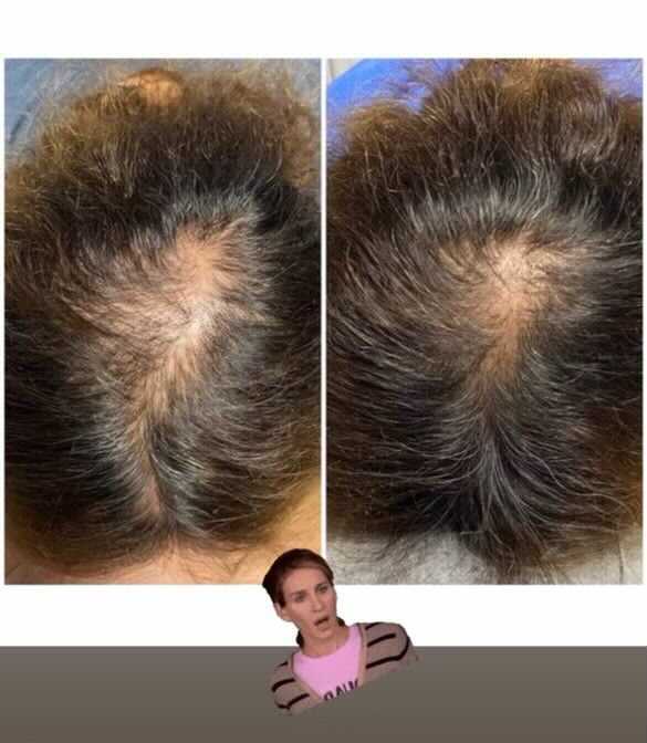 Two images show the top of a head with hair loss, before and after treatment, a person with a surprised expression.