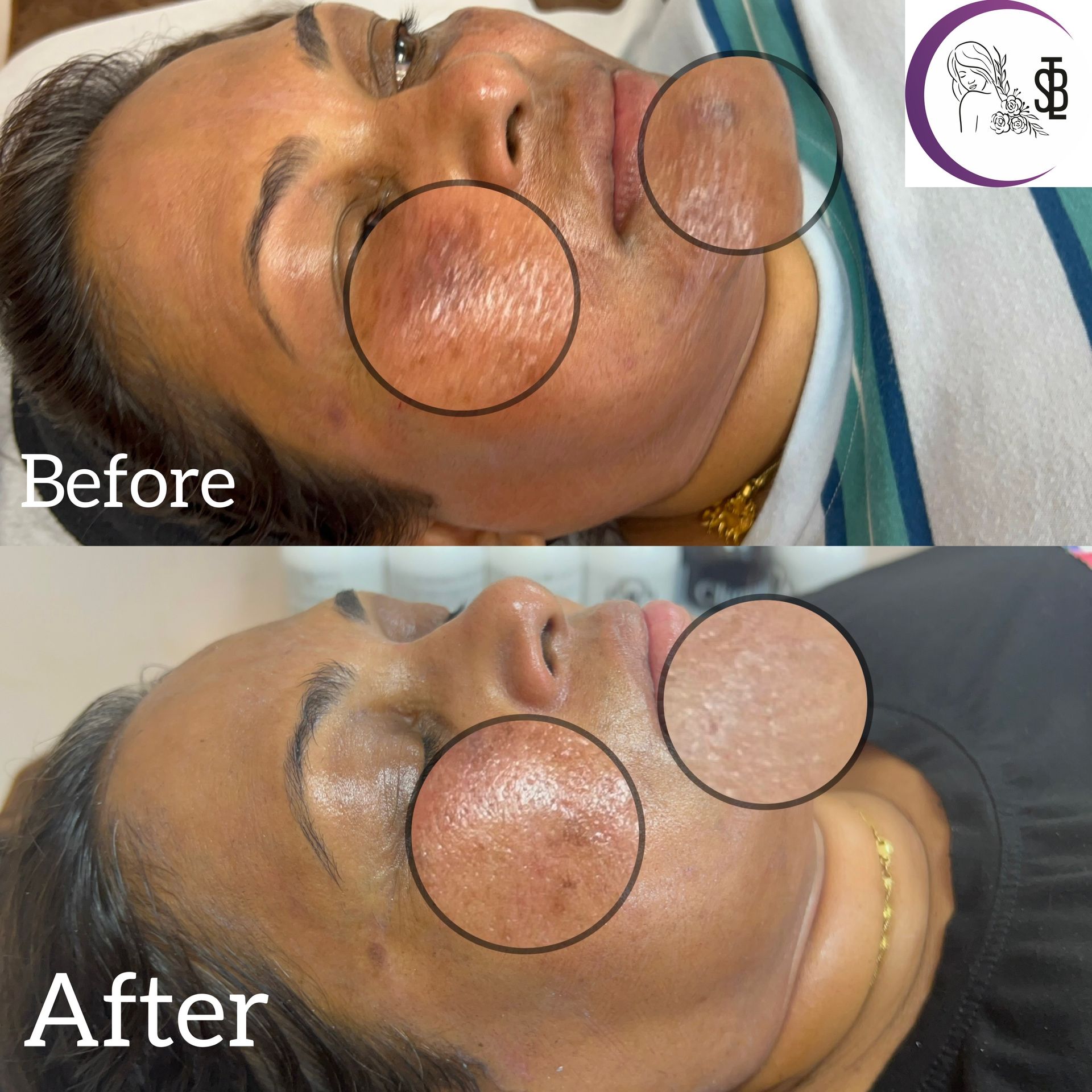 Before & after facial skin treatment. The woman's skin looks smoother and less discolored after the treatment.