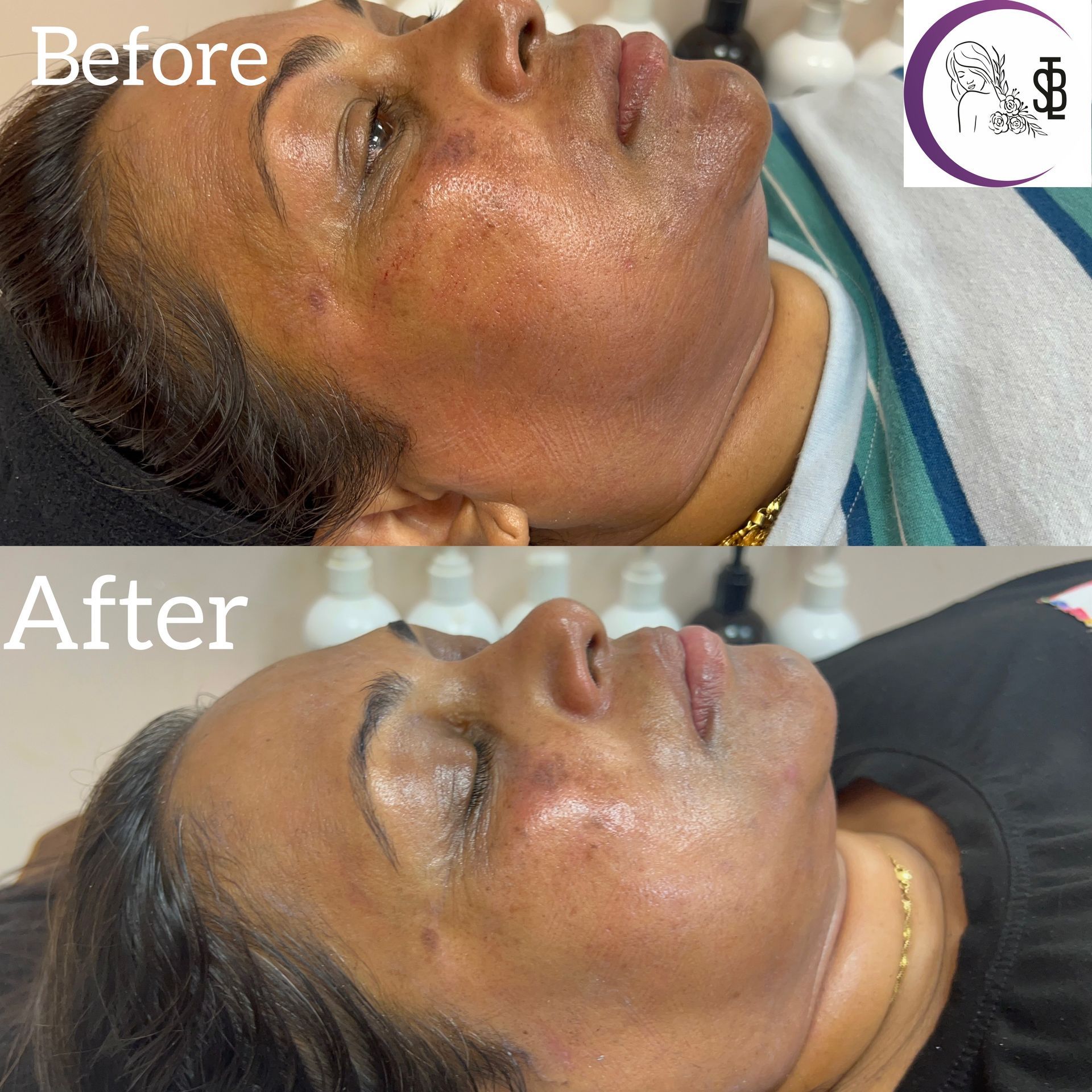 Comparison of a woman's face before and after a facial treatment, showing reduced discoloration.