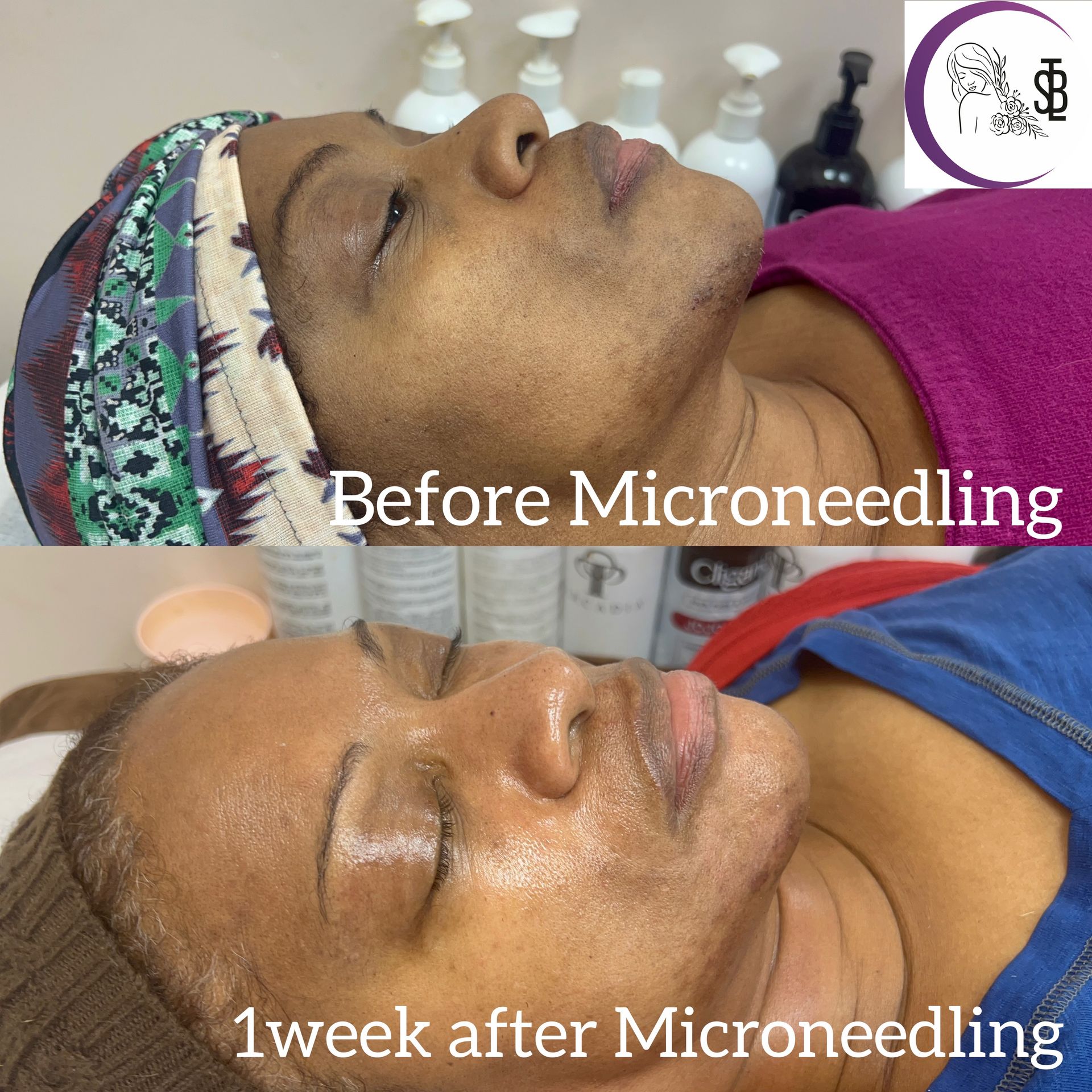 Comparison of a person's face before and one week after a microneedling treatment. Skin appears smoother after.