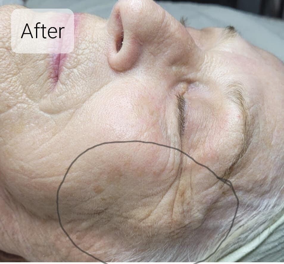 Close-up of a person's face showing skin texture and wrinkles, with an area highlighted in a circle.