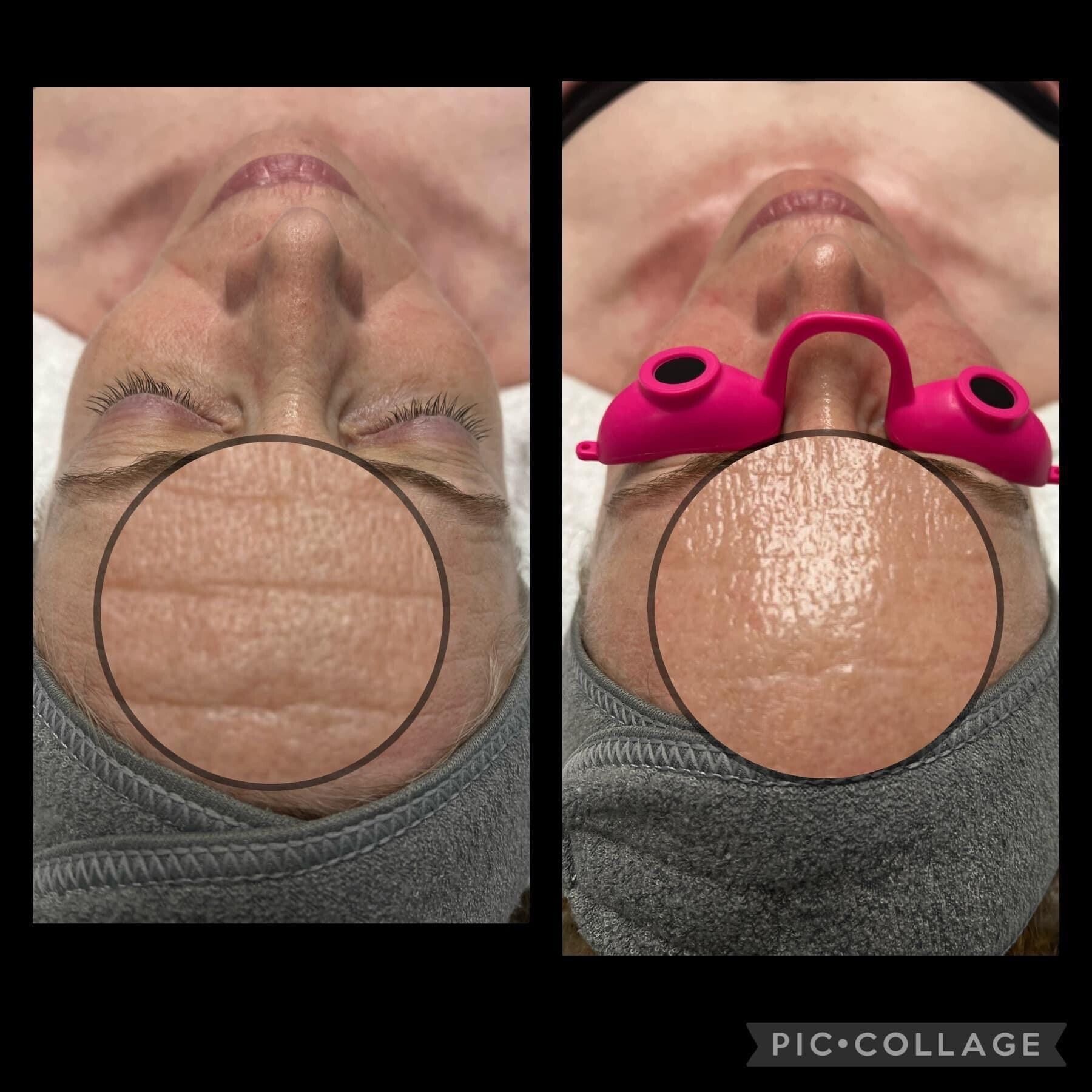 Two side-by-side facial views; before and after skincare treatment. Forehead wrinkles diminish post-treatment.