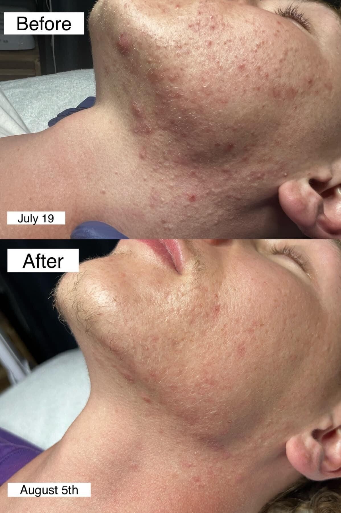 Comparison of a person's chin and jawline before and after skin treatment. Before shows acne; After shows clearer skin.