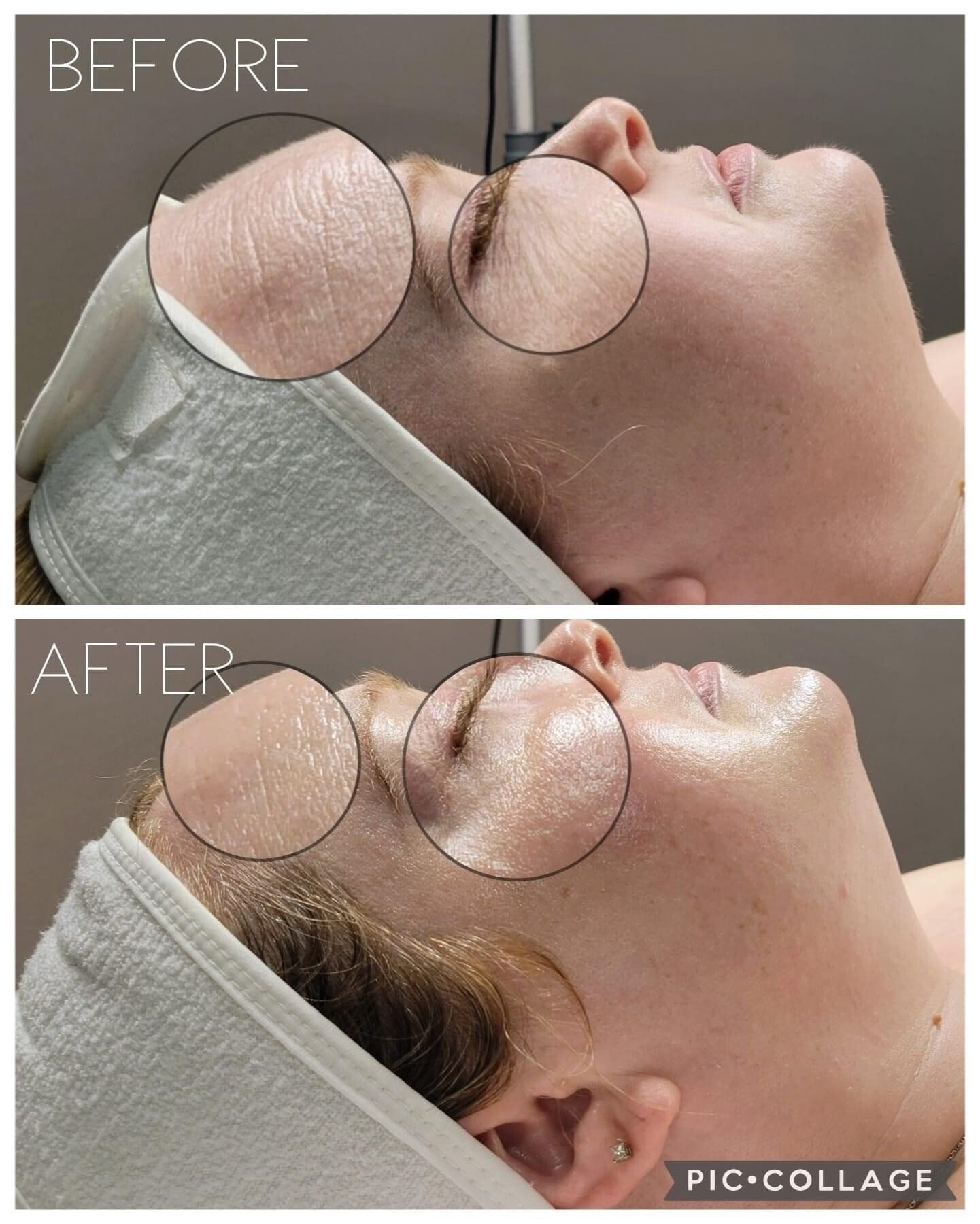Side-by-side comparison of skin before and after treatment, showing reduction in wrinkles and improved skin tone.