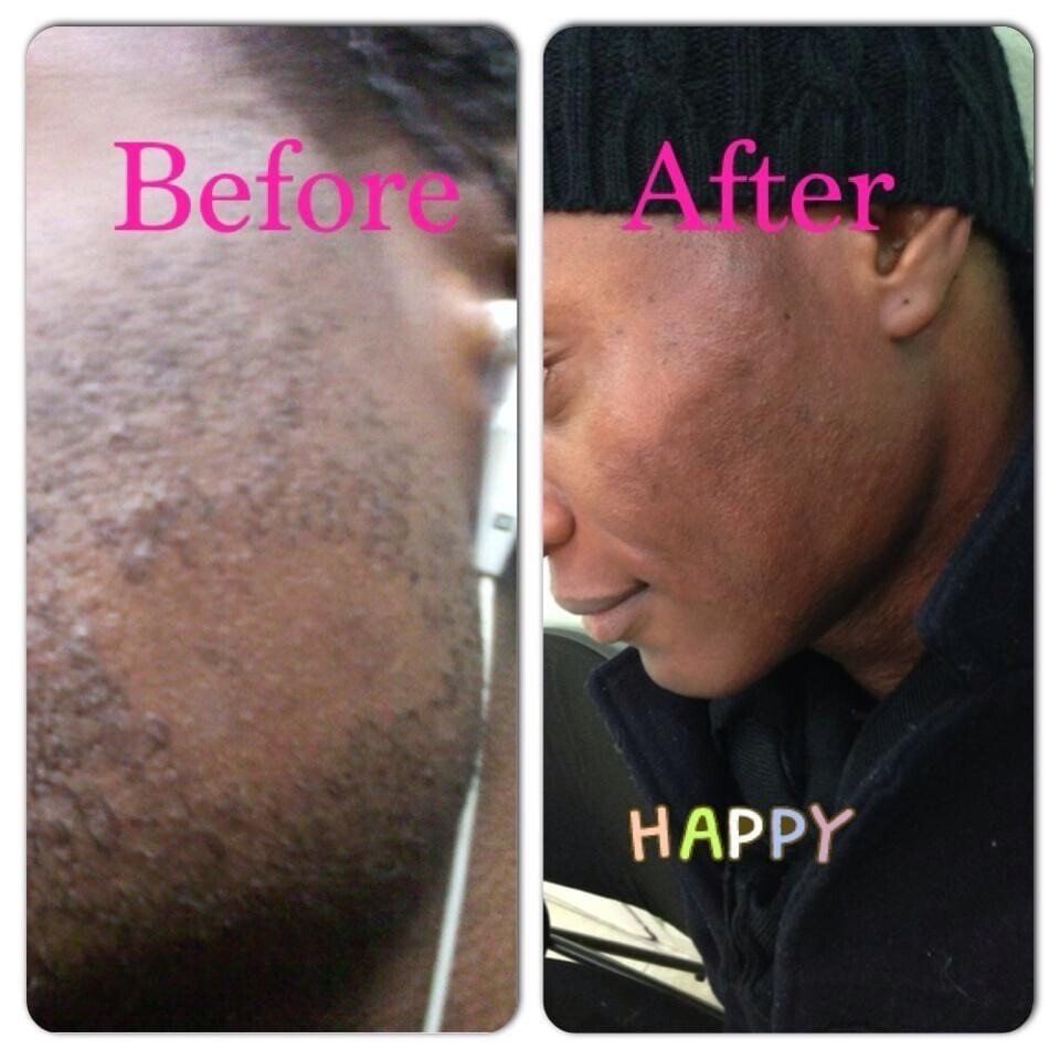 Comparison of a person's cheek before and after a treatment, with the 