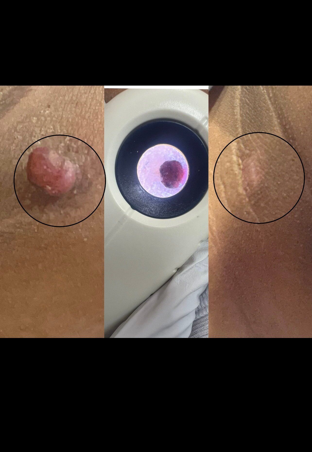 Three views of a skin lesion. Left: raised, red growth. Center: magnified view. Right: small, pinkish mark.