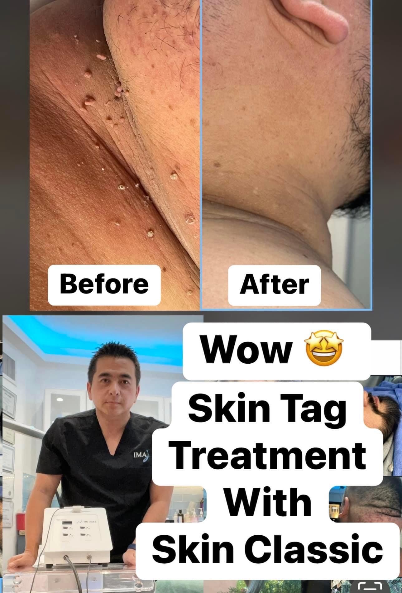 Before/after skin tag removal; man’s neck. Man in black shirt with machine. Text overlay: 
