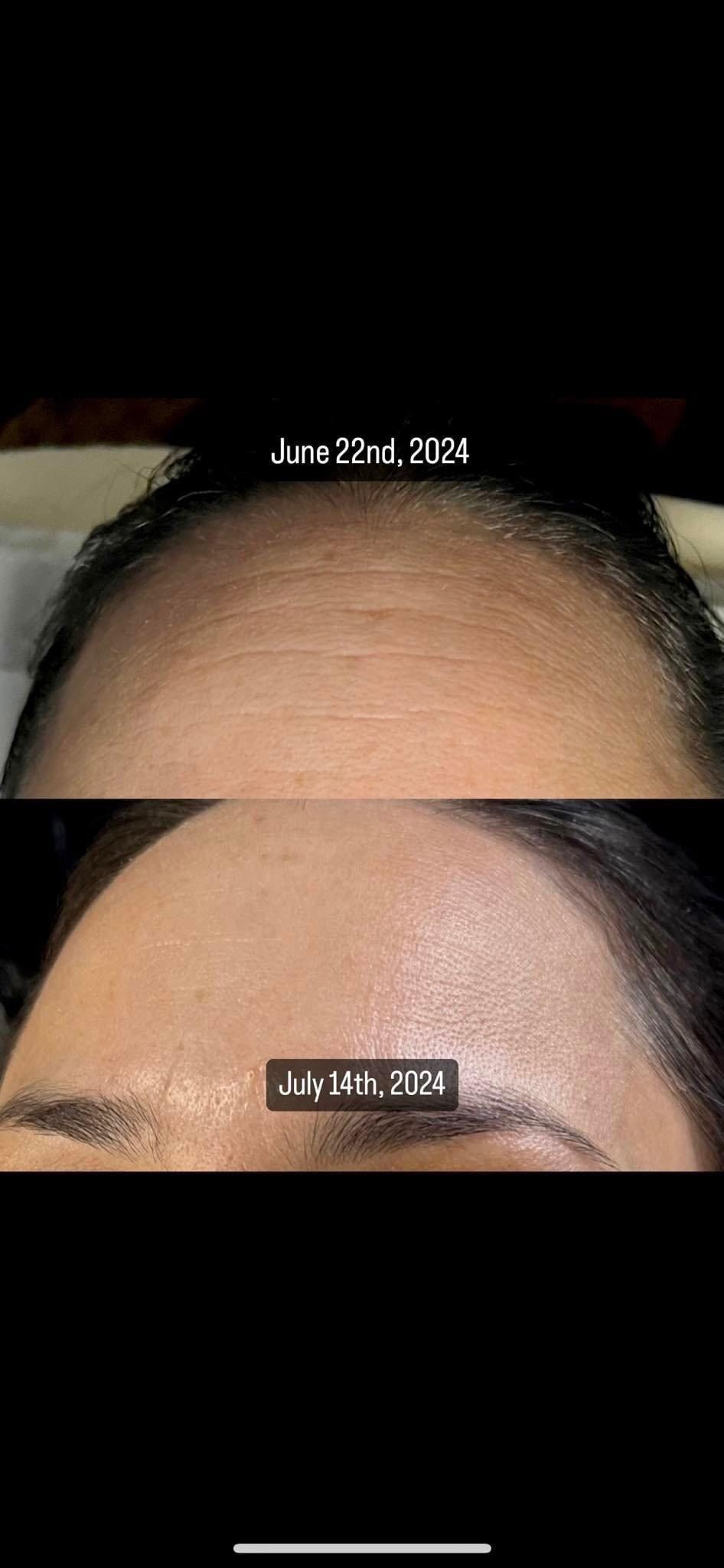 Comparison of a person's forehead before and after a treatment.