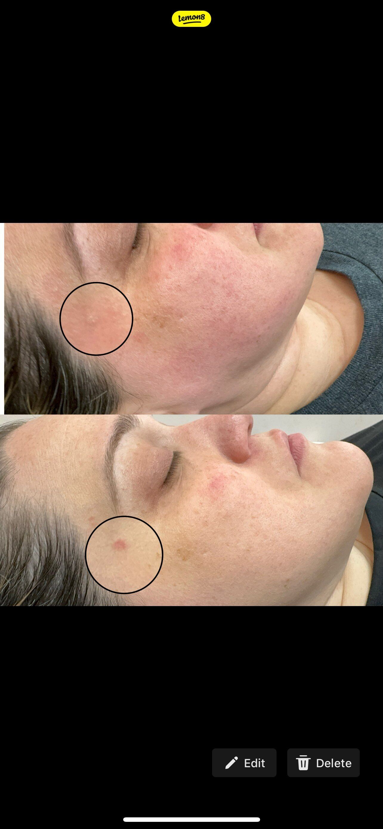 Two close-up views of a person's face. One shows a skin blemish on the cheek and the other on the eyebrow.