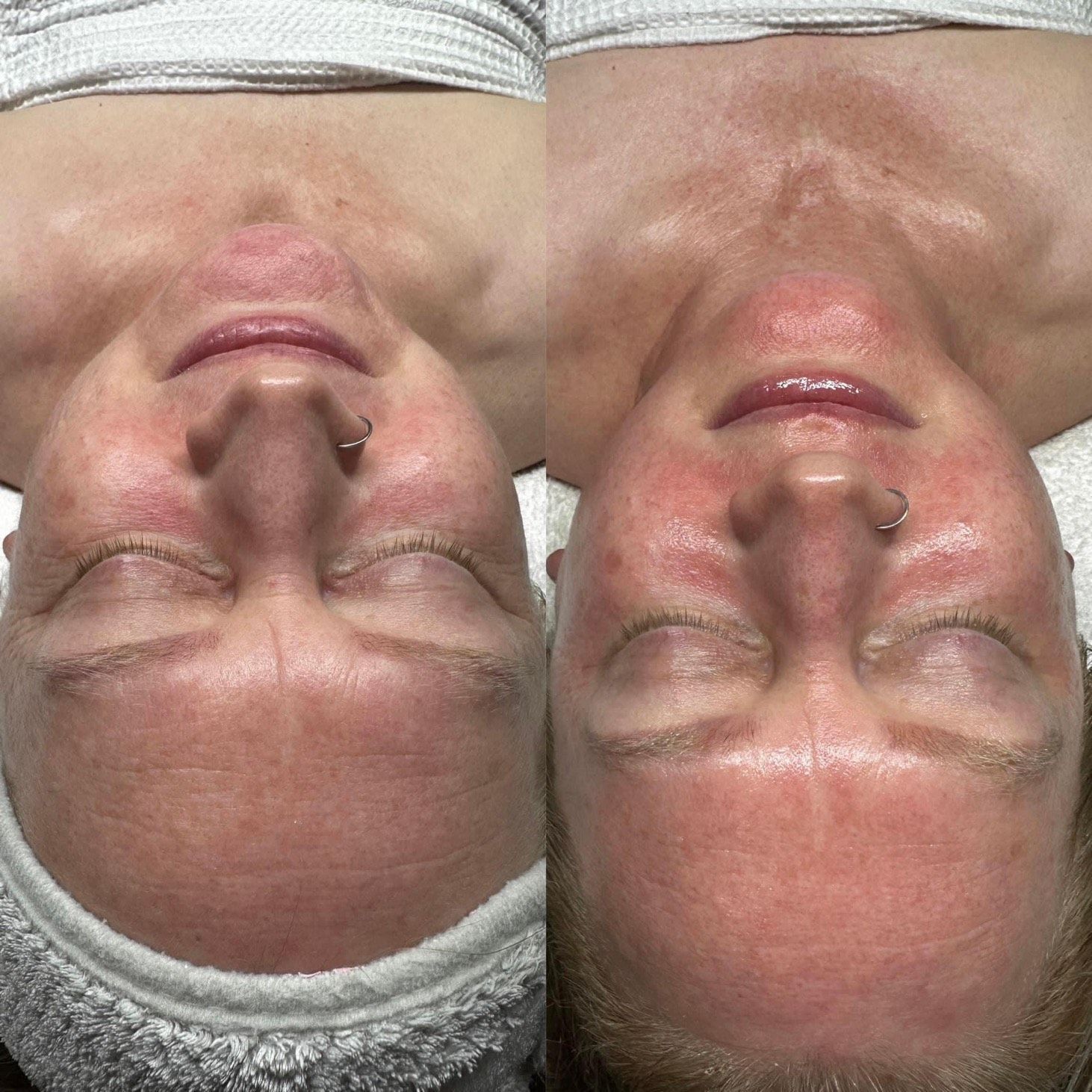 Side-by-side photos of a person's face. Left shows facial redness, right shows slightly reduced redness after treatment.