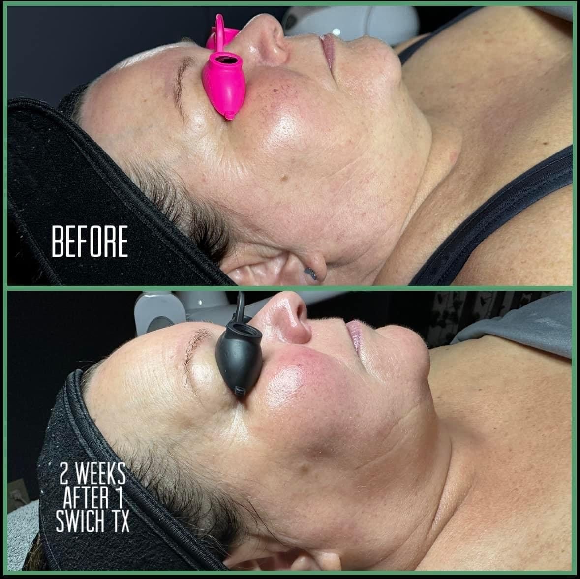 Comparison of a person's face before and two weeks after a skin treatment. Pink eye protection in both.