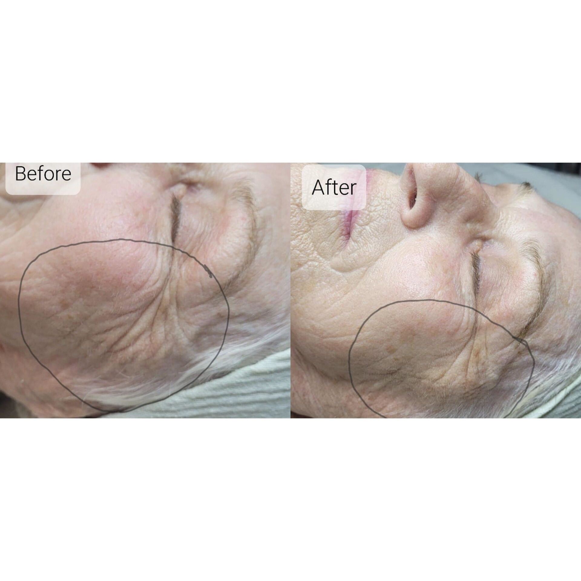 Side-by-side comparison of a person's face. Left side shows wrinkles; right side shows reduced wrinkles.