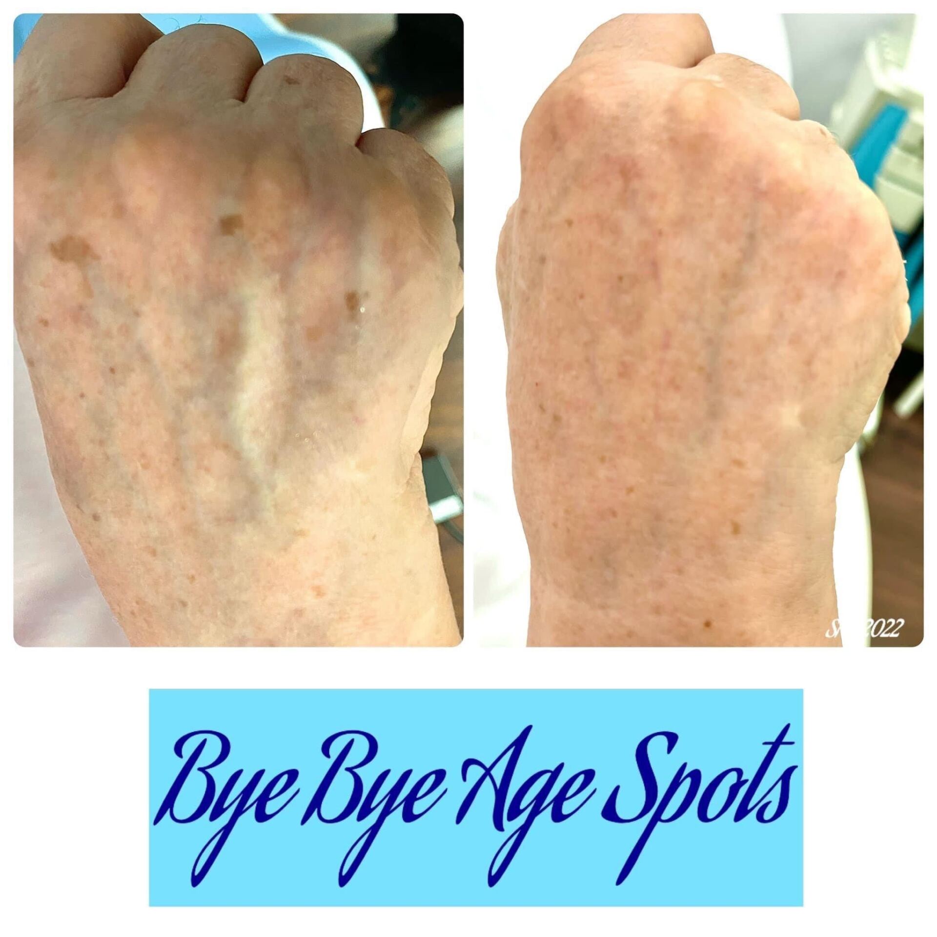 Two hands before and after a treatment. Reducing age spots is advertised.